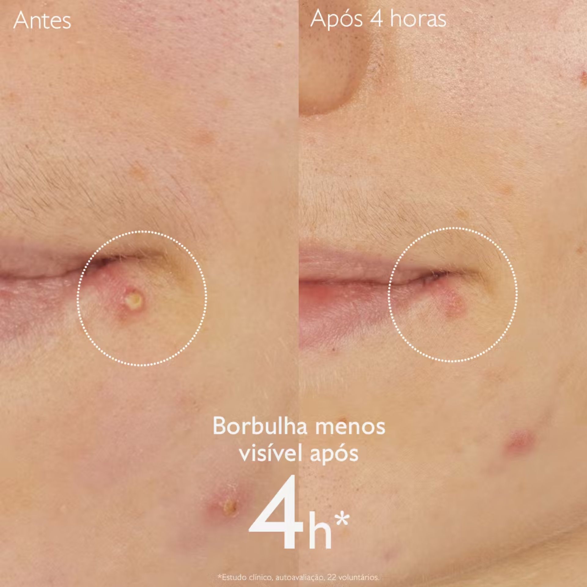 Caudalie Vinopure Stop Borbulhas Ácido Salicílico 15ml