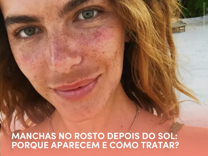 Hiperpigmentação após o sol: Hiperpigmentação após o sol:
