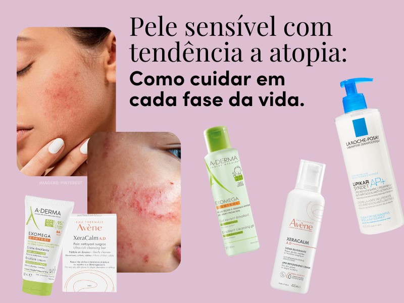 Pele sensível com tendência a atopia: como cuidar em cada fase da vida Pele sensível com tendência a atopia: como cuidar em cada fase da vida